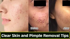 Clear Skin and Pimple Removal Tips